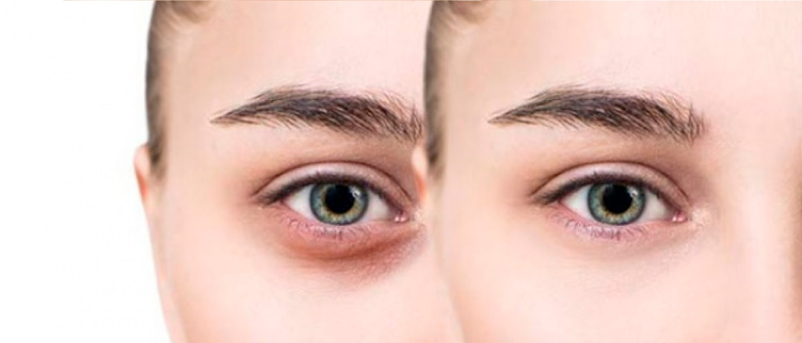 TRATAMIENTO PARA OJERAS CON RELLENO DÉRMICO