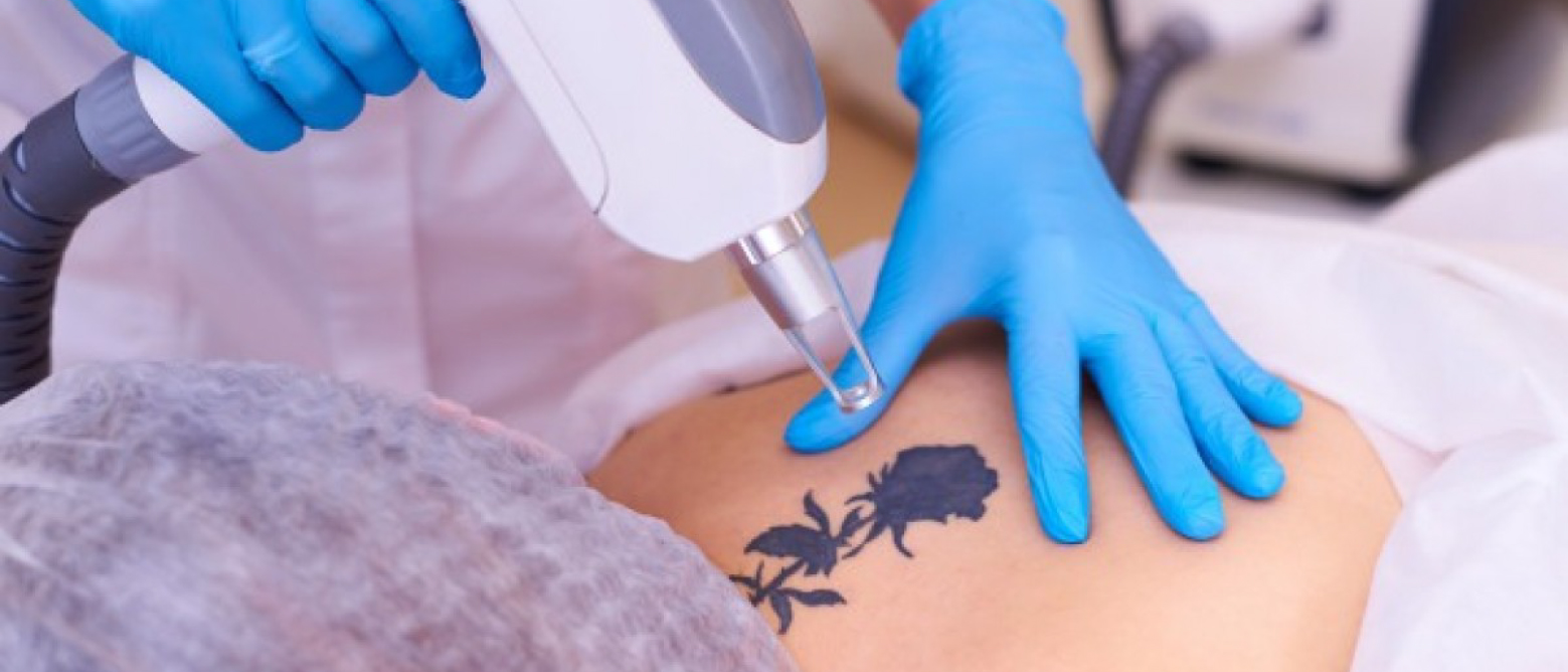 REMOCIÓN DE TATTOO