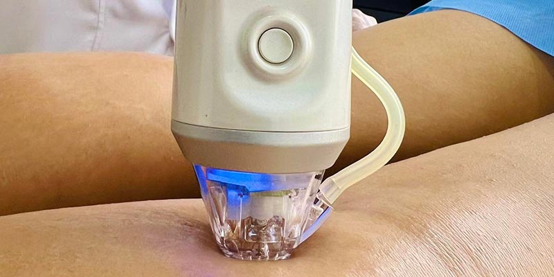 TRATAMIENTO PARA FLACIDEZ CON RADIOFRECUENCIA FRACCIONADA